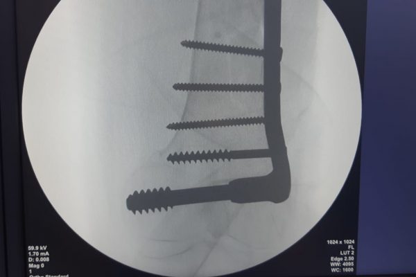 O echipă de medici de ortopedie și traumatologie a operat, în această dimineață, o pacientă de 73 de ani, din Ucraina, care suferise fractură de femur!